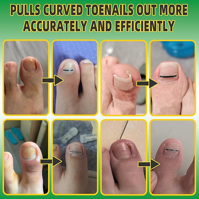 Ingrown Toenail Treatment Kit, Titanium Alloy Ingrown Toenail Removal Kit, Nails Corrector Tool & Remover Strips - Ingrown Toe Nail Quick Relief